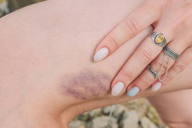 Domowe sposoby na krwiaki i siniaki – co naprawdę działa?